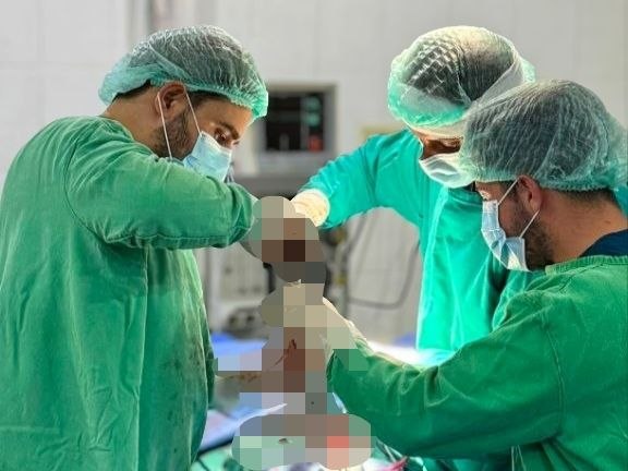 عملية جراحية نوعية لتصحيح تشوه فقري متقدم لطفل في مشفى دير عطية الوطني