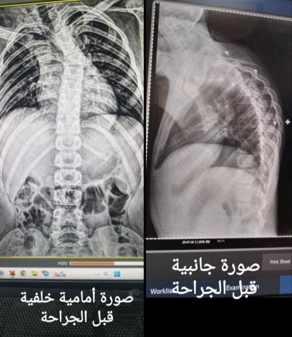 عملية جراحية نوعية لتصحيح تشوه فقري متقدم لطفل في مشفى دير عطية الوطني