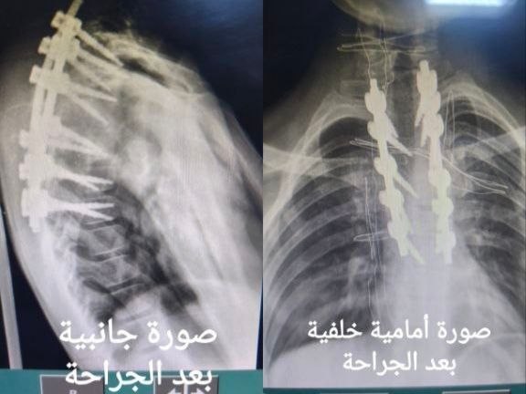 عملية جراحية نوعية لتصحيح تشوه فقري متقدم لطفل في مشفى دير عطية الوطني