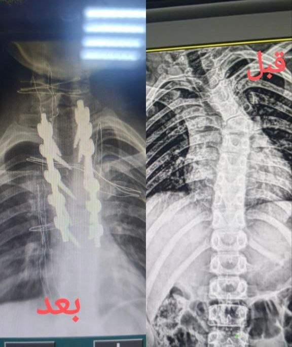 عملية جراحية نوعية لتصحيح تشوه فقري متقدم لطفل في مشفى دير عطية الوطني